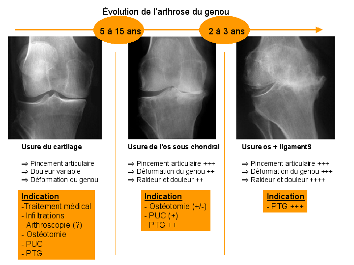 arthrose du genou et de la hanche - Kin-option